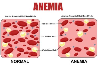 treatment of anemia in gurgaon, best gastroeneterologist in gurgaon, best doctor for treatment of anemia in gurgaon, dr mayank chugh liver specialist, Best Gastroenterologist and Physician at Asiaz Hospital