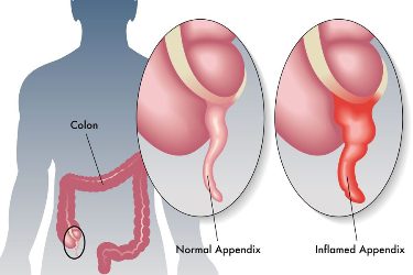 Dr Mayank Chugh, best doctor for the treatment of abdominal pain, best gastroenterologist for pain abdomen,  best gastro doctor in gurgaon, causes of abdominal pain, severe pain in the abdomen, Best Liver Specialist at Asiaz Hospital