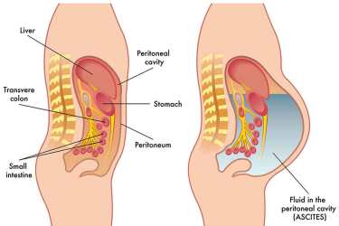 ascites - fluid collection Ascites Treatment in Bhiwani Haryana, Best Liver Specialist for Ascites in Bhiwani, Dr Mayank Chugh Best Gastroenterologist for Ascites