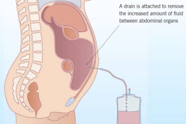 Ascites tapping Ascites Treatment in Bhiwani Haryana, Best Liver Specialist for Ascites in Bhiwani, Dr Mayank Chugh Best Gastroenterologist for Ascites