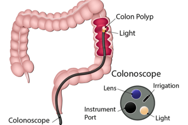 cost of colonoscopy in gurgaon, best doctor for colonoscopy in gurgaon, best gastro specialist doctor in gurgaon, best clinic for colonoscopy test, dr mayank chugh gastro specialist, best centre for colonoscopy test