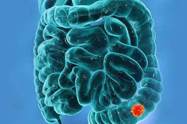 Colorectal Cancer Treatment in Gurgaon Colon Cancer Treatment in Bhiwani, Dr Mayank Chugh, Best Gastroenterologist in Haryana