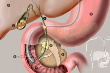 cost of ercp in gurgaon india, best hospital for ercp in Gurgaon India, best gastro specialist for ercp, treatment of cbd stones in Gurgaon, Dr Mayank Chugh Best Gastroeneterologist, Best Doctor for ERCP in Gurgaon, Asiaz Hospital