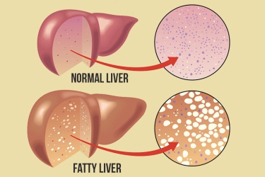 dr mayank chugh, best gastroenterologist in gurgaon, best doctor for fatty liver in gurgaon, best liver specialist near me, best gastro and liver clinic in gurgaon, Asiaz Hospital, Gurgaon