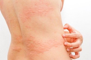 treatment of food allergy in Bhiwani, best doctor for food allergy treatment, dr mayank chugh best gastroenetrologist in Haryana