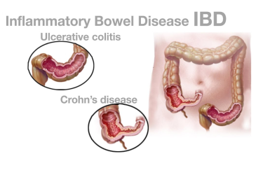 Inflammatory Bowel Syndrome IBD