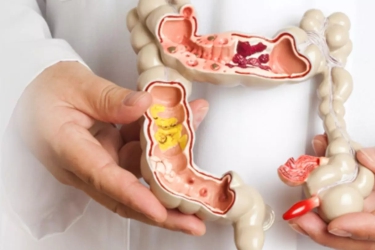 Colo-rectal study