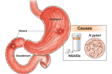 best doctor for stomach ulcer treatment, cost of stomach ulcer treatment, best gastro doctor for stomach ulcer, dr mayank chugh for stomach ulcer treatment, gastro & liver centre in Gurgaon, Haryana